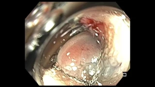 Colonoscopy: LST-NG Tumor Resection