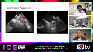 ICE Image of the Month (Feb 2023) Part II: ICE and Left Atrial Appendage Occlusion