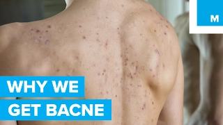 The Science Behind Why “Bacne” Happens to Good People - Sharp Science