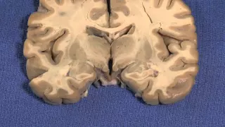 Hypothalamus: Neuroanatomy Video Lab - Brain Dissections