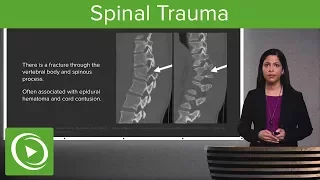 Spinal Trauma: Cervical Trauma Protocol, Common Spinal Fractures – Radiology | Lecturio