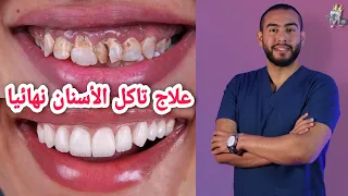 5 طرق لعلاج تاكل الاسنان فى المنزل👌| اسباب وعلاج تاكل الاسنان🥳 | تاكل الاسنان عند اللثه ومن الاعلى 🦷