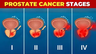 Silent Prostate Killer: Are You at Stage X Without Even Knowing?