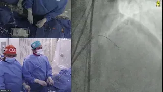 LIVE CASE 7 - PCI of LAD CTO with Antegrade Wiring Technique