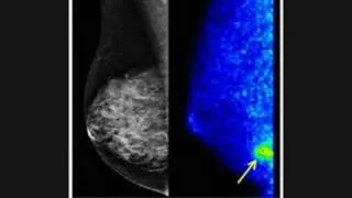New Screening Tool for Breast Cancer