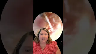 Ear wax removal