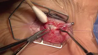 Surgery: Anteriorization of an Inferior Oblique Muscle in an Eye with DVD: Dr. Mary O'Hara