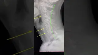 What does arthritis and degeneration look like on an x-ray?