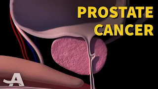 Early Signs of Prostate Cancer