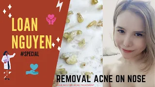 Specially remove BLACKHEADS on NOSE | Loan Nguyen