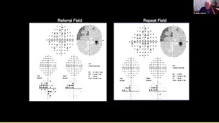 Lecture: Advanced Perimetry Interpretation: Recognizing and Dealing With Artifacts