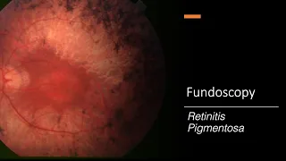 Retinitis Pigmentosa: Fundoscopy