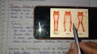 Osteoarthritis- primary and secondary OA- causes , treatment