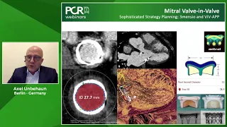 Transcatheter Mitral Valve-in-Valve: a safe alternative for an increasing patient population