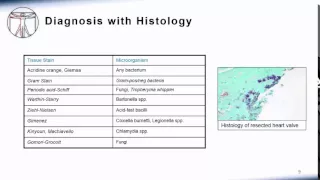 Endocarditis: Culture Negative Endocarditis