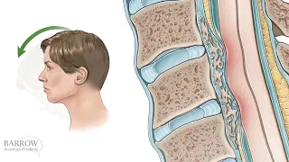 What is Degenerative Cervical Myelopathy?   Video Explanation