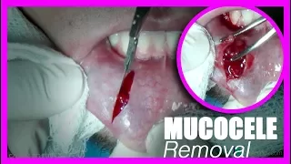 Mucocele Extraction