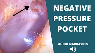 Small eardrum retraction pocket discovered behind wax and dead skin (eustachian tube dysfunction)