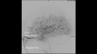 Trans-superior ophthalmic vein approach for treatment of carotid-cavernous fistula