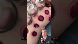 CUPPING GONE WILD...
