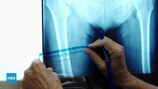 Hybrid Total Hip Arthroplasty│Preop Planning