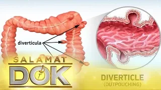 Salamat Dok: Information about diverticulitis