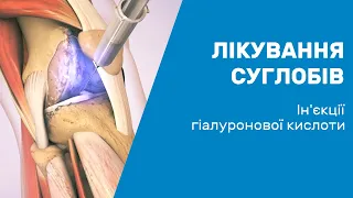 Лікування суглобів. Уколи гіалуронової кислоти / Уколы гиалуроновой кислоты в суставы