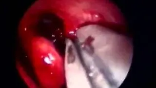 Endoscopic Primary DCR