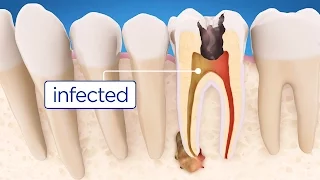 Root Canal Treatment Step by Step