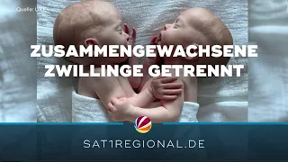 Zusammengewachsene Zwillinge erfolgreich am UKE in Hamburg getrennt