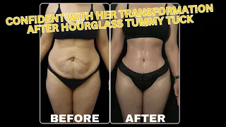 Confident with Her Transformation After Hourglass Tummy Tuck