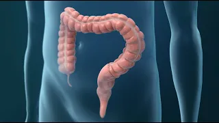 Treatments for Colorectal Cancer