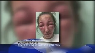 Girl gets poison ivy on eyes