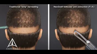 NeoGraft hair transplant procedure - animation