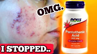 I COMPLETELY STOPPED TAKING PANTOTHENIC ACID FOR ONE WEEK || DID MY ACNE COME BACK WORSE?!