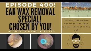 HUGE EAR WAX REMOVAL, EARDRUM PEEL AND FOREIGN BODY REMOVAL? - EP400