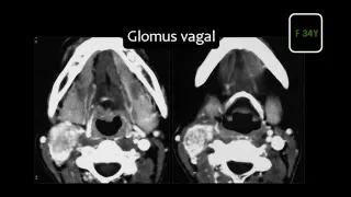 Imaging of Infrahyoid neck part 2   Dr Mamdouh Mahfouz