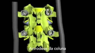 Cirurgia de artrodese da coluna - como funciona