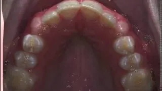 Orthodontic Expansion without a palatal expander