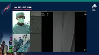 Live Case Presentation #5 FEMORAL POPITEAL IN-STENT RESTENOSIS