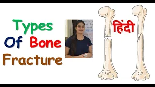 Types of Fracture in Hindi | Bones Fracture | RajNEET Medical Education