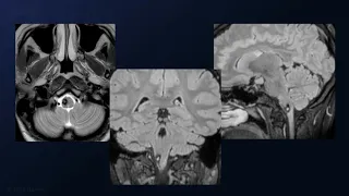 Far Lateral Craniotomy for Resection of an Olivary Medullary Cavernous Malformation