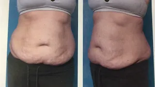 Tummy Tuck Surgery Before and After! #tummytuck #cosmeticsurgery