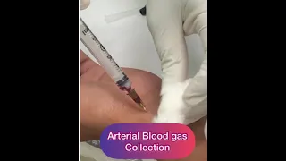 Arterial blood sample collection