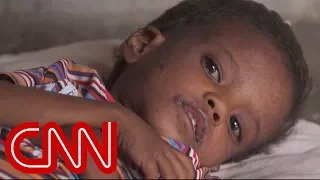 Yemen's children are silently starving to death