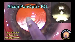 is the Alcon PanOptix trifocal IOL the best choice for cataract surgery?