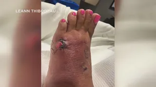 Flesh-eating bacteria suspected in Florida woman | 10News WTSP