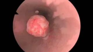 Polypectomy / Polyp Removal - New Features for Virtual Reality Surgical Simulation