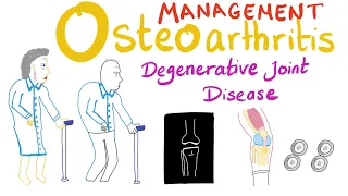 Osteoarthritis (OA) Treatment - Part 6 (last part) - Rheumatology Series