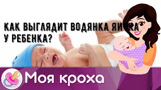 Как выглядит водянка яичка у ребенка?